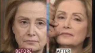 Facelift Surgery Featured on Fox  Facial Plastic Surgeon [upl. by Towne246]