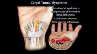 Carpal Tunnel Syndrome Diagnosis Explained  Science Based [upl. by Bearnard]