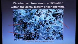 Cure Periodontitis Antiparasitic and Microscopic Method Dr Bonner [upl. by Story]