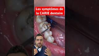 Les symptômes de la CARIE dentaire [upl. by Alam]