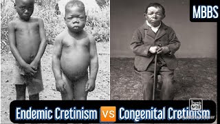 Endemic Cretinism 🆚 Congenital Cretinism  MBBS NEXT NEETPG [upl. by Eslud]