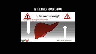 Is the liver recovering cirrhosis liver transplante livercirrhosis [upl. by Euqnomod]