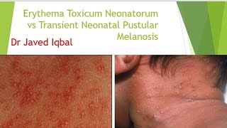 Erythema Toxicum Neonatorum VS Transient Neonatal Pustular Melanosis [upl. by Emmit]