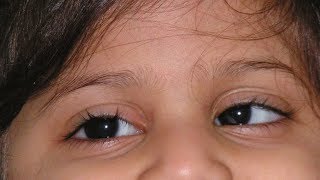 Can eye exercises help in correction of Squint  Dr Sriram Ramalingam [upl. by Adahs]