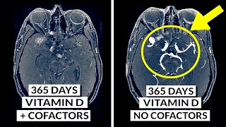 How To Safely Increase Vitamin D Levels Supplements Sunlight amp Cofactors [upl. by Kendry]