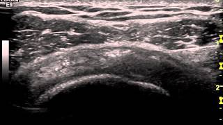 Ultrasound Guided Injection of the Subacromial Bursa  Dr Peter Resteghini [upl. by Rape771]