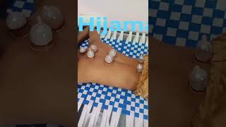 hijama hijamacupping hijamatherapy [upl. by Akram387]