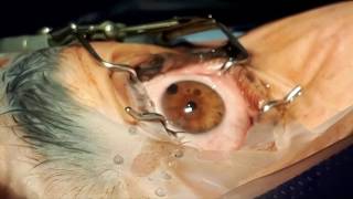 Corneal tattoo for laser peripheral iridotomy [upl. by Siroval]