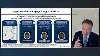 Improving the Recognition and Management of ARIA in Alzheimer’s Disease Treatment [upl. by Enelyaj]