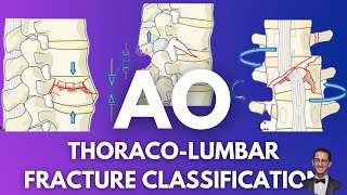 AO Classification Thoracolumbar Fractures [upl. by Ashatan823]