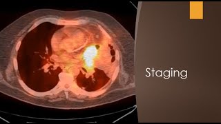 Staging of NSCLC by PET CT SCFHS PETCT PETCT nuclearmedicineMCQ frcr [upl. by Yxel]