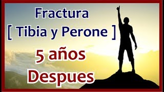 • FRACTURA TIBIA Y PERONE  • 5 AÑOS DESPUES ◄ [upl. by Nalid]