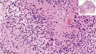 Glioblastoma  Histopathology [upl. by Hesper]