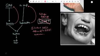 LeschNyhan syndrome  Pathology [upl. by Stroud]