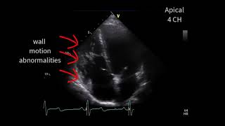 A special cardiomyopathy [upl. by Enaelem206]