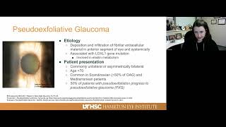 Lecture Pigmentary and Pseudoexfoliative Glaucoma [upl. by Erie490]