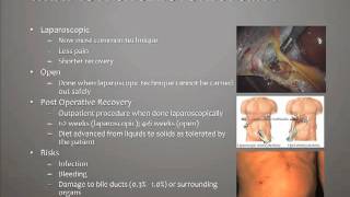 What is a Cholecystectomy [upl. by Oina]