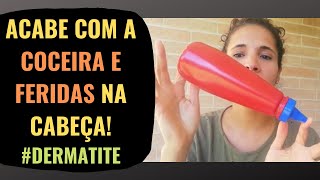 ELIMINE a Coceira e Feridas na cabeça dermatite [upl. by Theta]