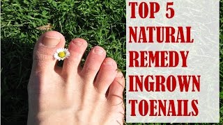 Top 5 Natural Remedies for Ingrown Toenails [upl. by Artened]