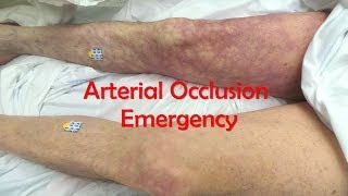 Acute Complete Occlusion of the Leg Arteries [upl. by Brouwer722]