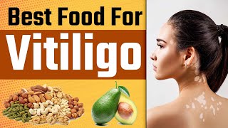 Best Diet Plan For Vitiligo Patient  Best Food For Vitiligo  White Patches   Dr health [upl. by Kosiur732]