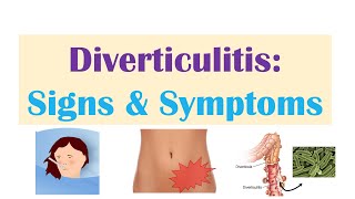 Diverticulitis Signs amp Symptoms And Why They Occur [upl. by Ikaz]