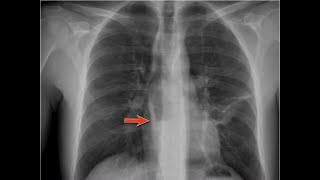 Medical Radiology  Overview of Chest Xray 1A [upl. by Ikuy]