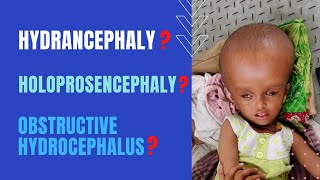 Clinical Picture Hydrancephaly Holoprosencephaly  Obstructive Hydrocephalus [upl. by Judsen]