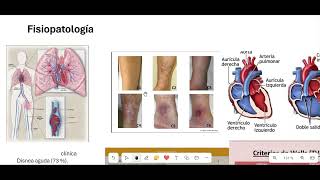 TROMBOEMBOLISMO PULMONAR PARTE 1 FISIOPATOLOGIA [upl. by Ynafit]