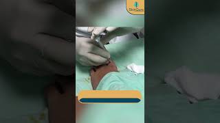 Ingrown Toenail Removal Surgery at SkinQure [upl. by Nomit323]