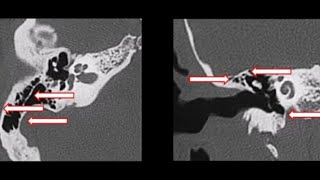 CT petrous temporal bone Surgeon vision  Cortical mastoidectomy preoperative checklist [upl. by Roselba294]