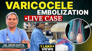 Live Case  Grade 3 Varicocele Embolization  NonSurgical Treatment of Varicocele  Dr Arun Gupta [upl. by Mikaela337]