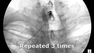 Cervical Interlaminar Epidural Steroid Injection  ThePainSourcecom [upl. by Alvera]