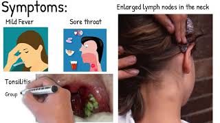 Infectious mononucleosis  Easy explained [upl. by Long]