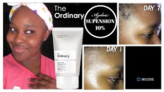 7 DAYS USING ORDINARY AZELAIC ACID SUSPENSION 10 FOR ACNE HYPERPIGMENTATION INFLAMMATION ROSACEA [upl. by Nageek837]