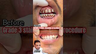 Cheapest teeth whitening procedure live😍 viralvideo dentist [upl. by Llerud]