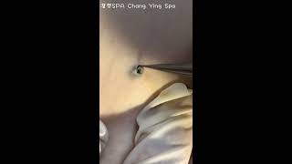 深層黑頭 Deep DPOW extraction  澄熒SPA [upl. by Egedan]