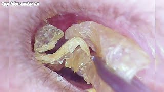 Ear Wax Removal 109 He Couldnt Sleep Because His Earwax Was Wet And Itchy  Ear Cleaning ASMR [upl. by Korwin]