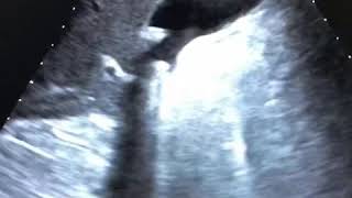 Litiasis vesicular Quiste renal Ecografia abdominal Vesicular lithiasis Renal cyst ultrasound [upl. by Virgie]