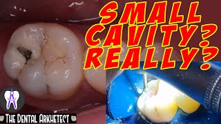 Molar Tooth Caries Removal and Restoration Pasta sa Bagang42 [upl. by Eentrok]