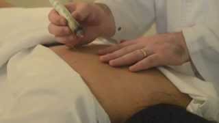 Demonstration of Moxibustion Treatment [upl. by Lucania]