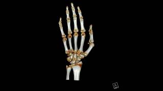 4th and 5th Metacarpal base fracture [upl. by Gilpin]