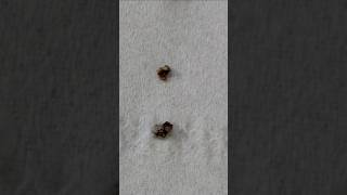 25mm stone breake and removed after ESWL 5 sessions kidneystone stones ESWL [upl. by Jez]