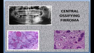 Central Ossifying Fibroma [upl. by Gowrie154]