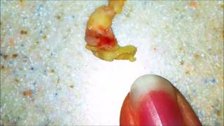 Worlds Largest Tonsil Stones  Cured [upl. by Mendie132]