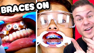 How Braces Are Put On  Watch Before You Get Braces [upl. by Eelrac]