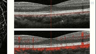 OCT Angiography Revolutionizing Vitreoretinal Disease [upl. by Nnep]