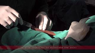 Coronary angiogram  a live demonstration [upl. by Allehcim]