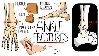 Ankle Fractures Made Easy [upl. by Znieh]