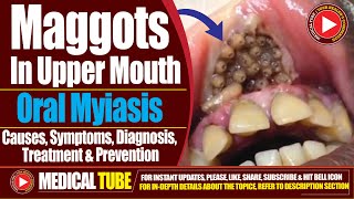 Maggots in Upper Mouth  Oral Myiasis  Causes Diagnosis and Treatment [upl. by Sik]